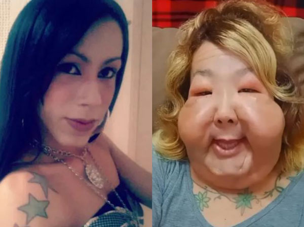 “프랑켄슈타인처럼 변했다” 브라질 트랜스젠더, ‘이것’ 잘못 받았다가 봉변