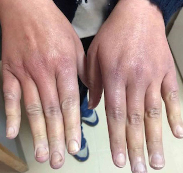 “‘이렇게’ 변한 손, 대장암 신호일 수도”… 40대 女, 겪은 사연 보니?