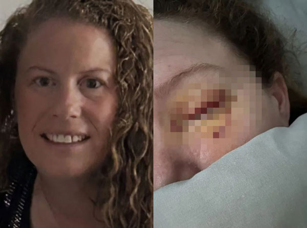 흐릿한 시야 방치했다가 안구 제거까지… 30대 女, 원인 뭐였나?