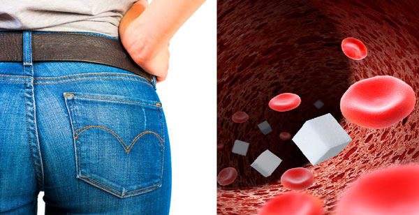 엉덩이 모양만 봐도 당뇨병 위험 알 수 있다… 남성은 작고, 여성은 크다