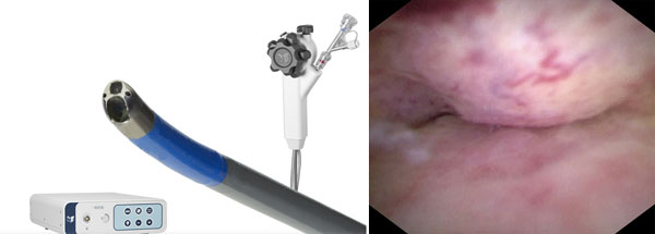 순천향대 부천병원, ‘아이맥스 담도내시경’ 도입