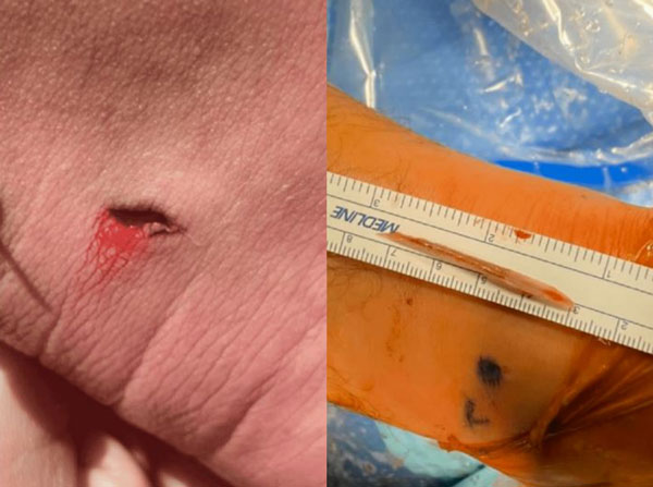 “극심한 통증 탓 발 봤더니, ‘이것’ 박혀있어”… 40대 男, 휴가 중 겪은 사연은?