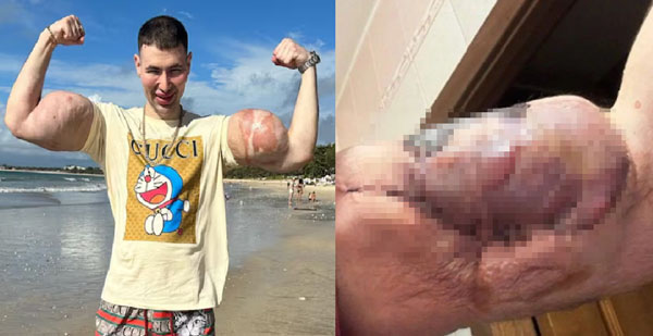 “잘못된 판단으로 두 팔 절단 위기”… 러시아 격투기 선수, 무슨 일?