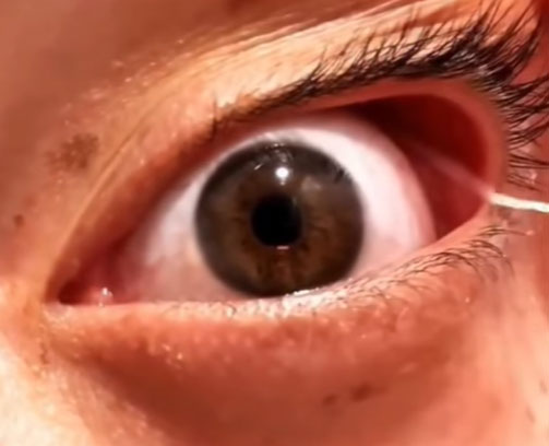 눈에서 나온 가느다란 실… ‘이 질환’ 신호였다