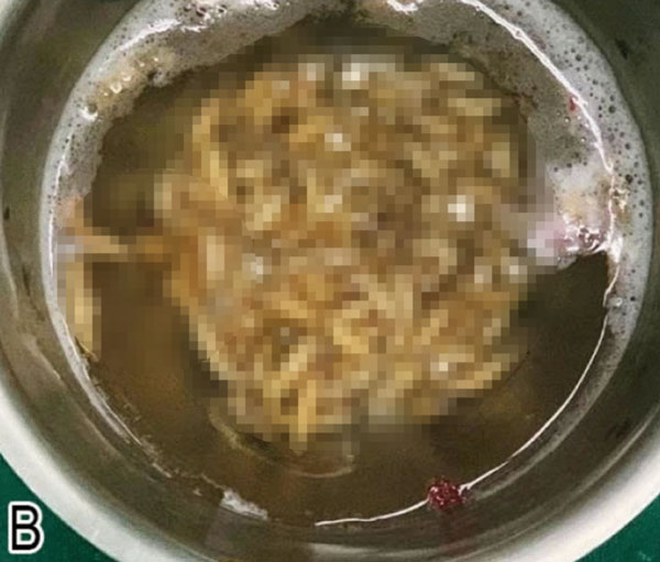 “이게 다 콧속에서 나왔다고?” 50대 여성 ‘이 벌레’ 발견... 어쩌다가?