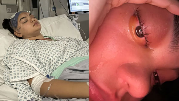 “감기인 줄 알았는데” 10대 女, 뇌수술 받아… 겪은 증상 뭐였을까?