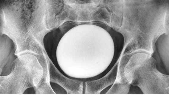 “배가 딱딱해” 35세 男, 방광서 거대한 ‘이것’ 발견… 뭐였을까?