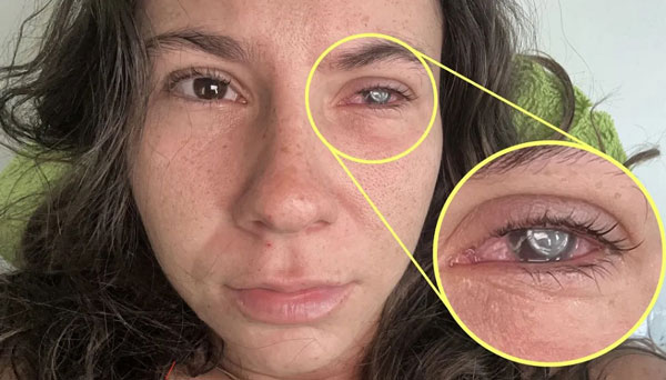 버스 탔다가 손 안 씻은 20대 女, 결국 실명… 무슨 일?