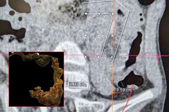 “배 아프다”던 아이 위장 속에서… 1미터 ‘이것’ 발견, 뭐였을까?
