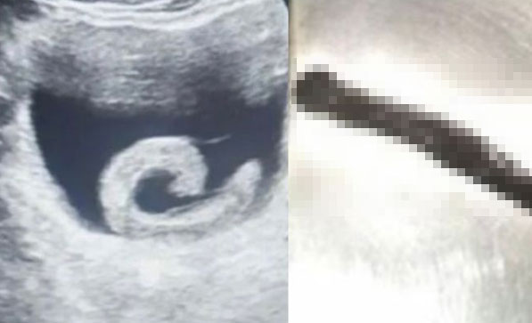 20대 男 방광서 5cm 거머리 ‘꿈틀’… “직접 넣었다”, 도대체 왜?