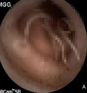 “계속 혈변 나오더니… 장에 ‘이것’ 붙어있었다” 40대 女, 무슨 일?