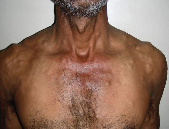 “온몸에 생긴 멍울, 기생충이었다”… 40대 男, 대체 무슨 일?