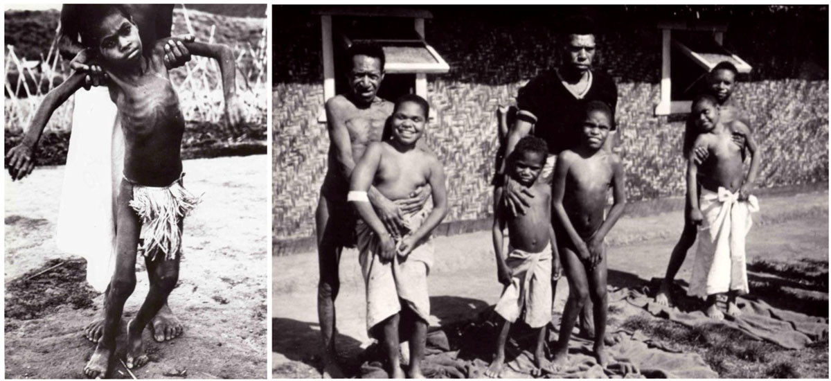 ‘끔찍한 장례 문화’ 탓에 생긴 불치의 병… 쿠루병을 아시나요?