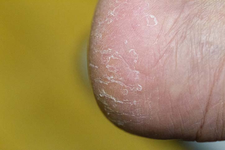 갈라진 발뒤꿈치, ‘이 증상’까지 있다면… 무좀 의심