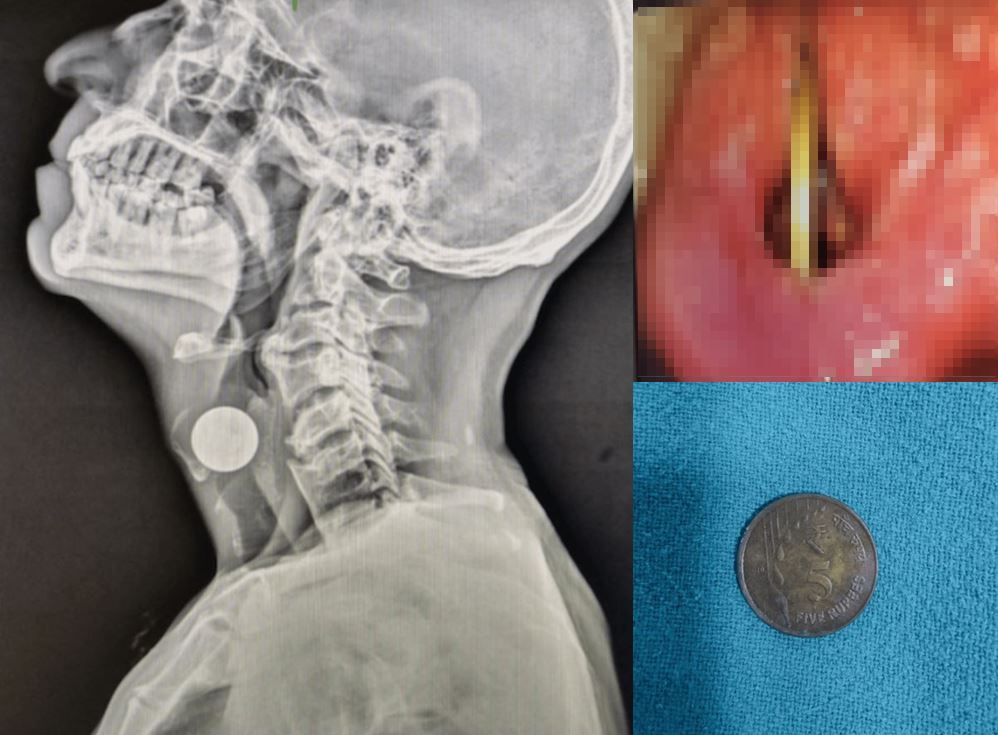 술 먹고 한 장난인데… 목에 ‘이것’ 박혀 목소리 안 나온 男, 무슨 일?