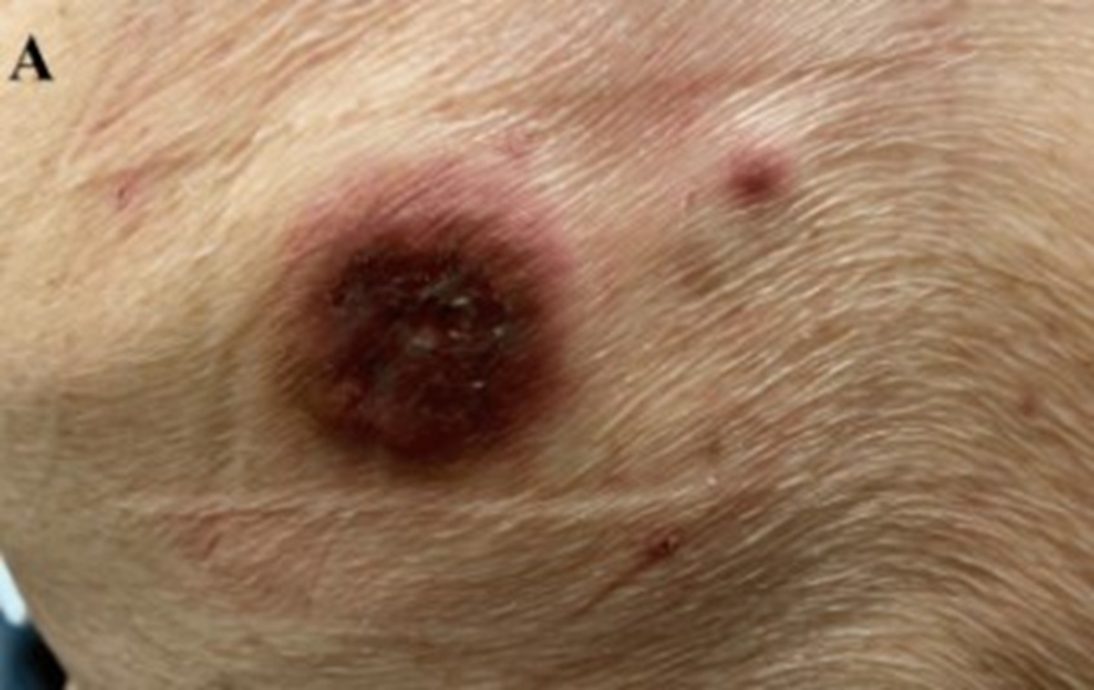 “피부에 ‘이 증상’ 나타나면, 6개월 안에 사망”… 90대 男 겪은 일 보니?