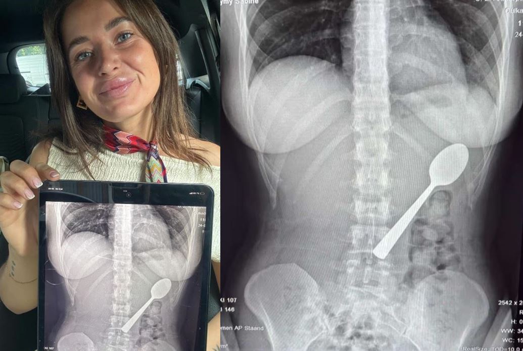 “창피해서 남자친구에게 숨겨”… 17cm ‘이것’ 삼키고 응급실 간 女