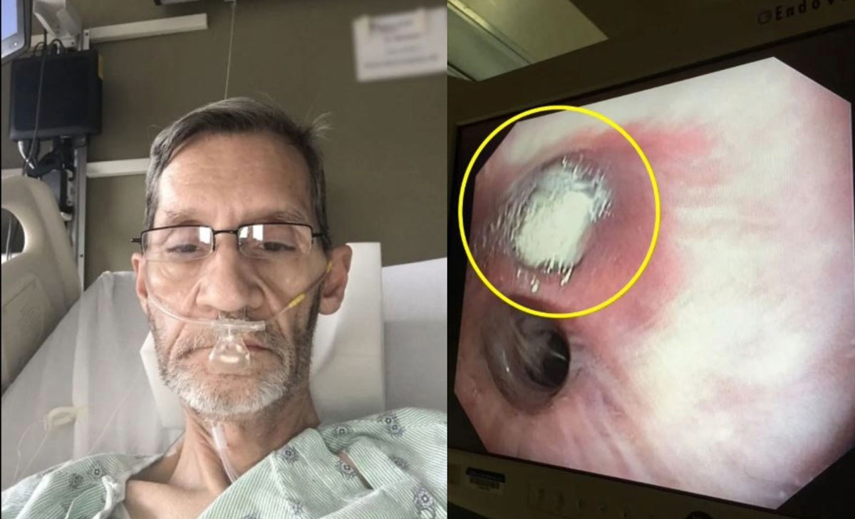 “‘이것’ 한 조각이 폐에 박혀서”… 5년 뒤 폐 적출한 英 남성, 무슨 사연?