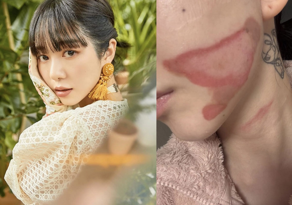 AOA 권민아, “잠들었다가 깨보니 살 찢어지는 고통”… 대체 무슨 일?