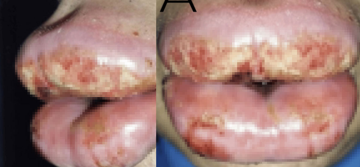 29세 트랜스젠더, 입술에 대체 무슨 일? 흔한 ‘이 시술’ 탓이라던데