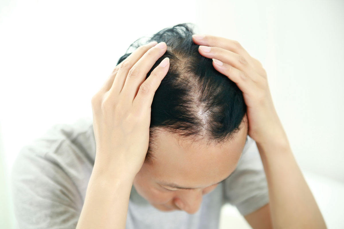 탈모인이 공통으로 보이는 특징… “낮은 비타민D 수치”