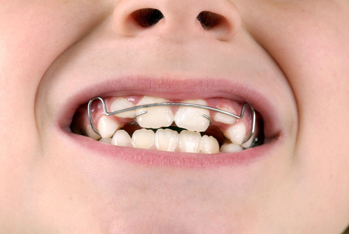 “아이들 치아 교정은 ‘이때’ 해라”… 치과 교수 조언은?