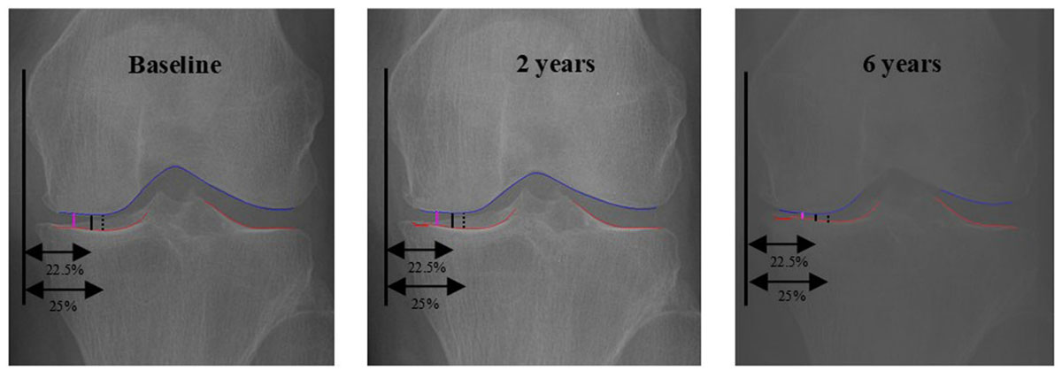 관절염 가장 심하게 닳은 부위, AI가 찾아낸다