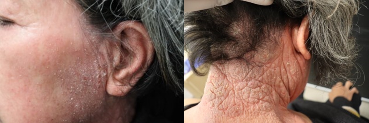 지루성 피부염 환자