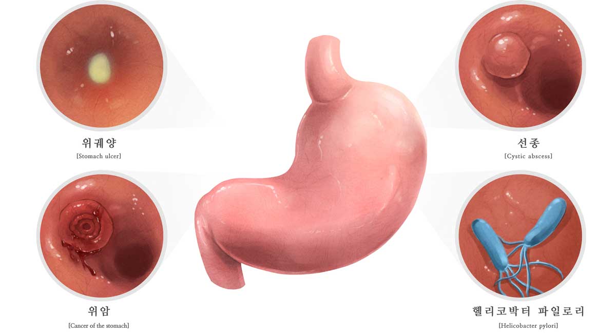 위 질환 종류