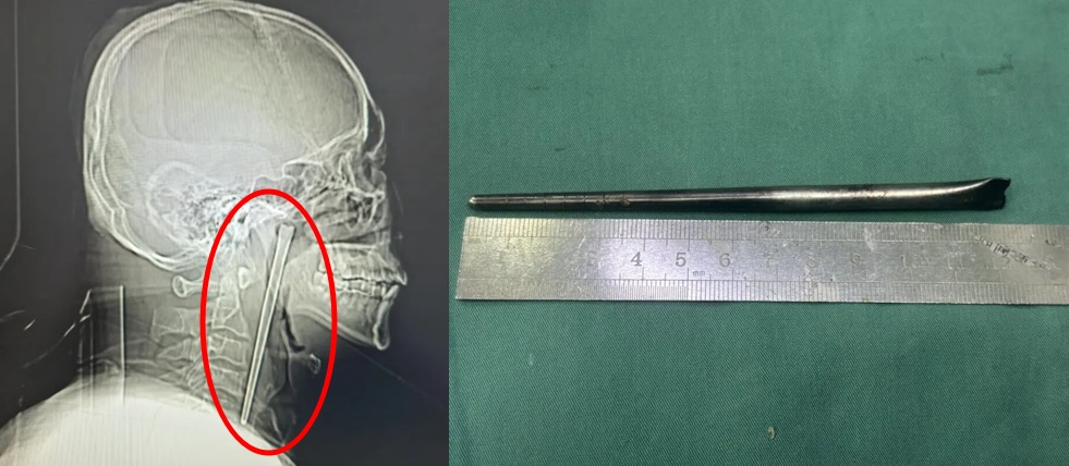 젓가락 삼킨 남성의 사례 사진