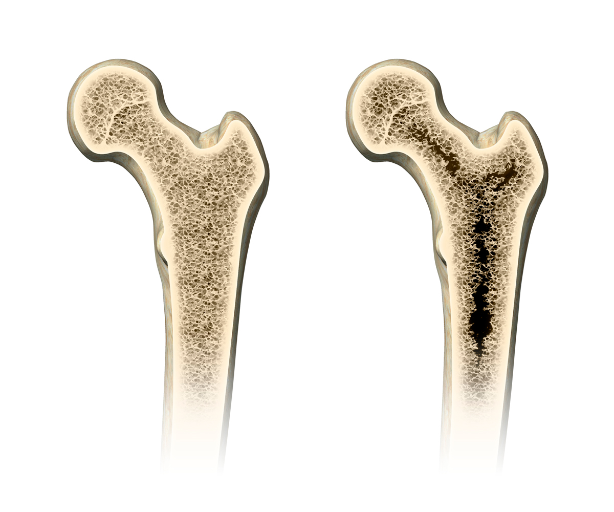 정상인 뼈와 골다공증에 걸린 뼈 사진
