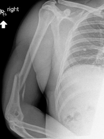 남성의 엑스레이 사진