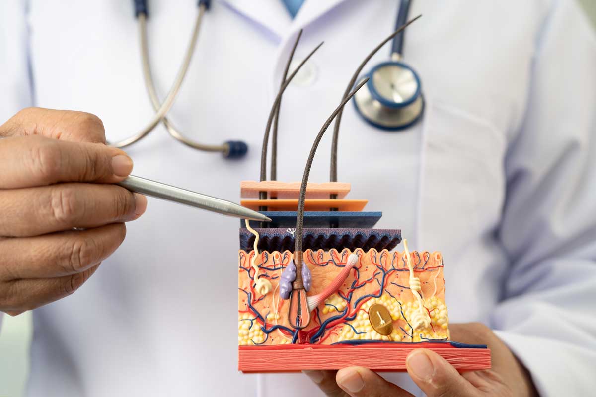 모낭 모형을 든 의사