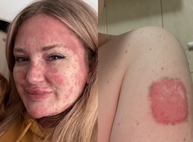 발진 여성 얼굴과 팔 사진