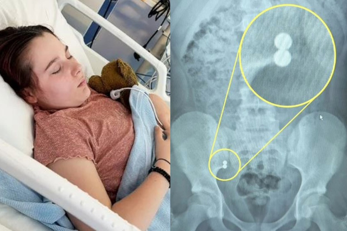 벨라 우달과 엑스레이 사진