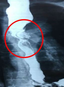 “9년 전 삼킨 틀니가 왜 여기에?” 60대 男 겪은 일 보니