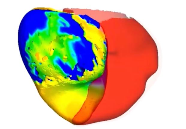 환자의 심장 디지털 트윈
