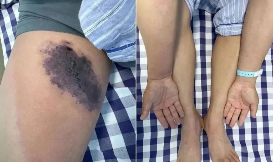 거미에 물린 남성