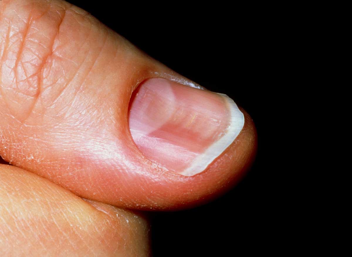 오목한 손톱 모양