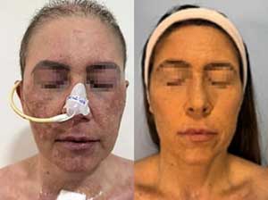 외국인 여성 얼굴 부작용 사진