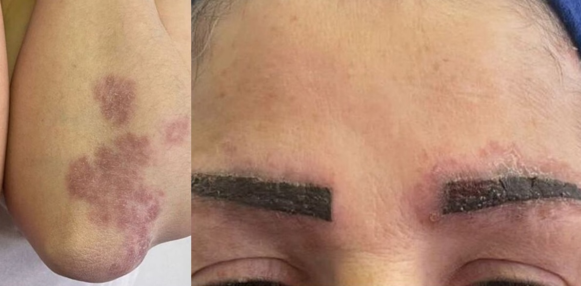 사르코이드증이 발생한 30대 여성