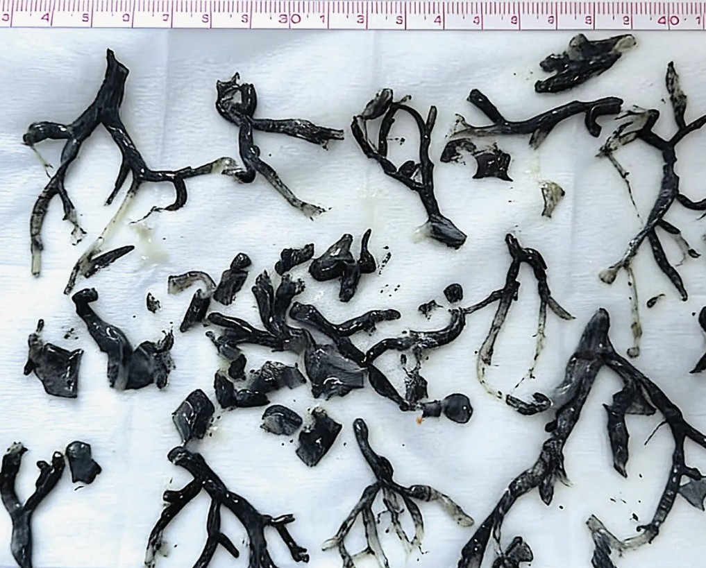 폐에서 발견된 이물질