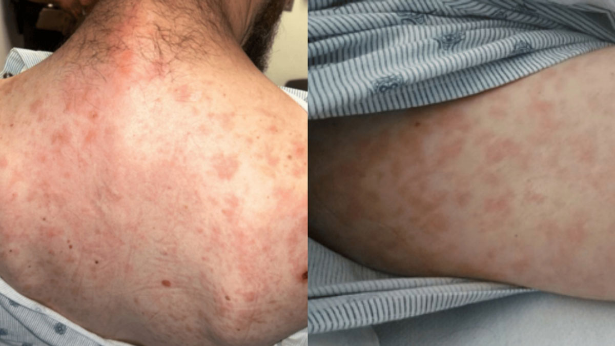 피부 발진 사진