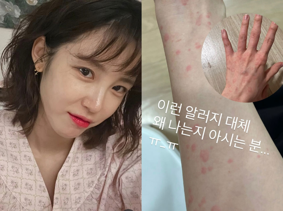 전효성 사진과 알레르기 사진