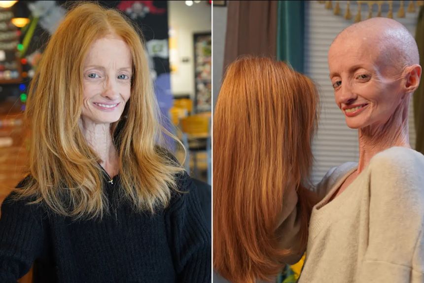 치아·머리카락 모두 빠진 40대 女... 한 번쯤 들어본 '이 질환' 탓 - 뉴스 썸네일 이미지