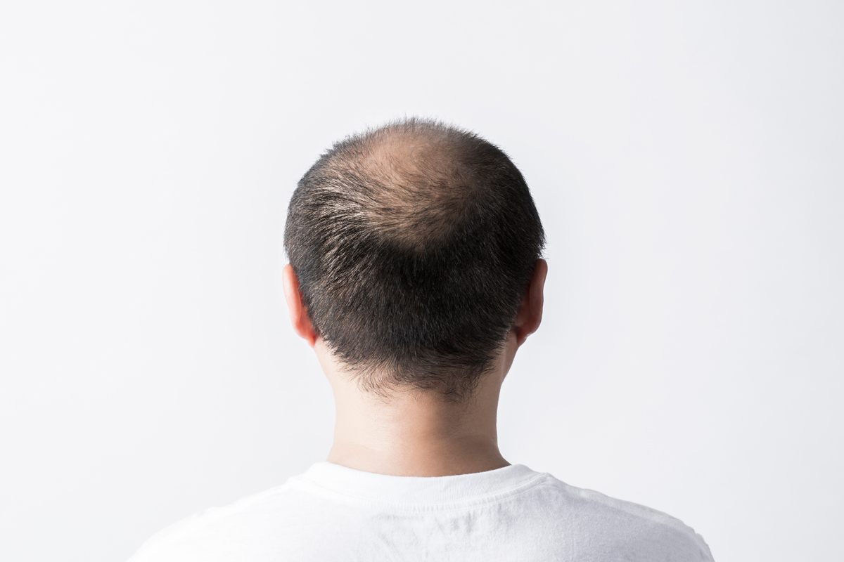 정수리 탈모인 사람