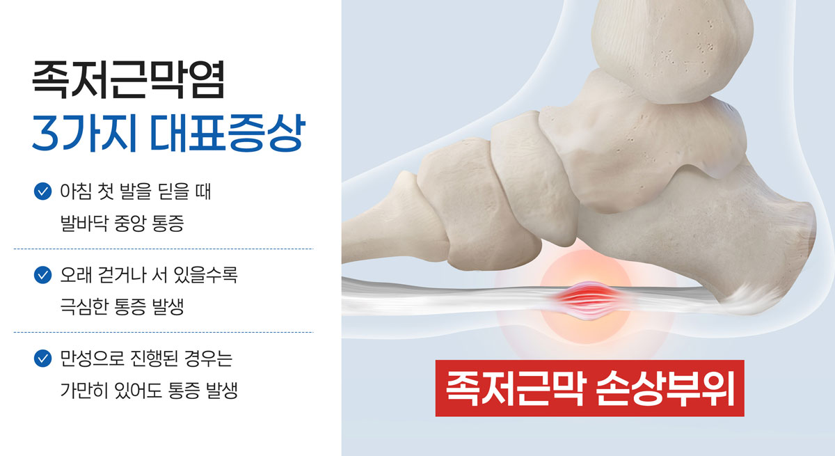 족저근막염 설명 사진