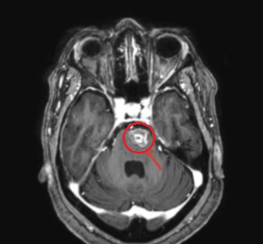 MRI 사진