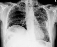 �ڷγ�19 ���� ����, ���� ȯ�ڰ� �پ��ٰ�?