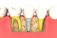 ���ö�Ʈ�϶�µ��� �� �ؾ� �ұ�?